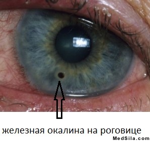 Окалина на глазу